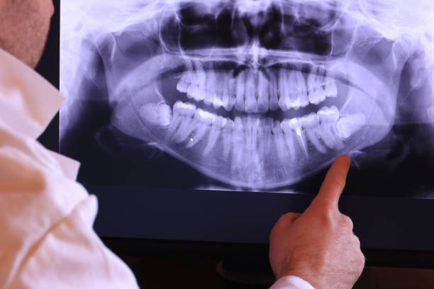 Best Emergency Wisdom Tooth Extraction in Saltillo, MS